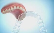 Afbeelding van de nachtbeugel Essix